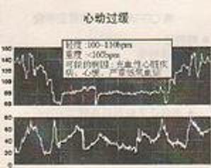 极速型心率