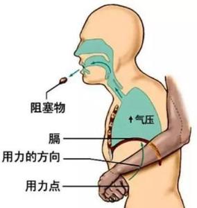 气管阻塞