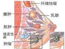 乳房肿块