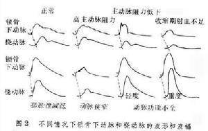 脉搏波的波形
