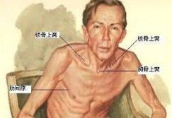 三凹征