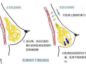 下垂乳房原因