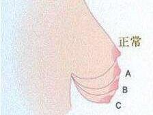 下垂乳房检查