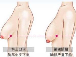 下垂乳房
