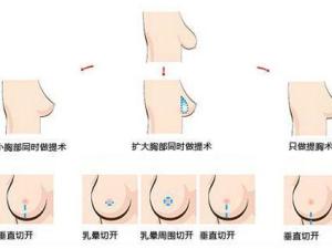 下垂乳房治疗