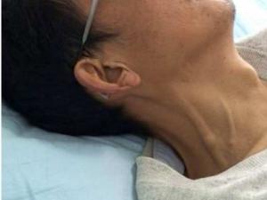 颈静脉怒张