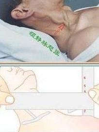 颈静脉怒张