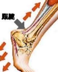 腓肠肌撕裂