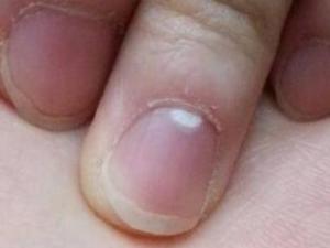 手指甲有白色斑点