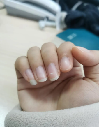 手指甲有白色斑点