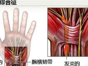 腕管综合征