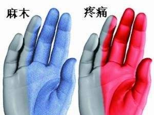 腕管综合征