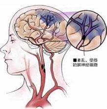 血管性头痛
