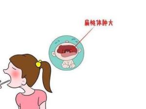 扁桃体肥大