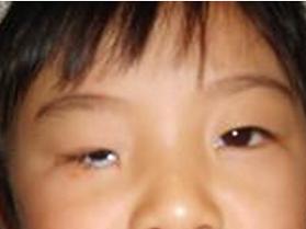 小眼球