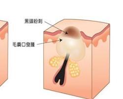 黑头粉刺