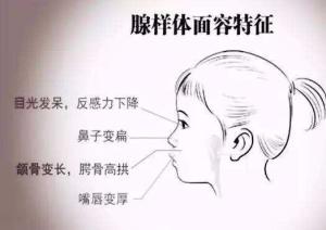 腺样体面容